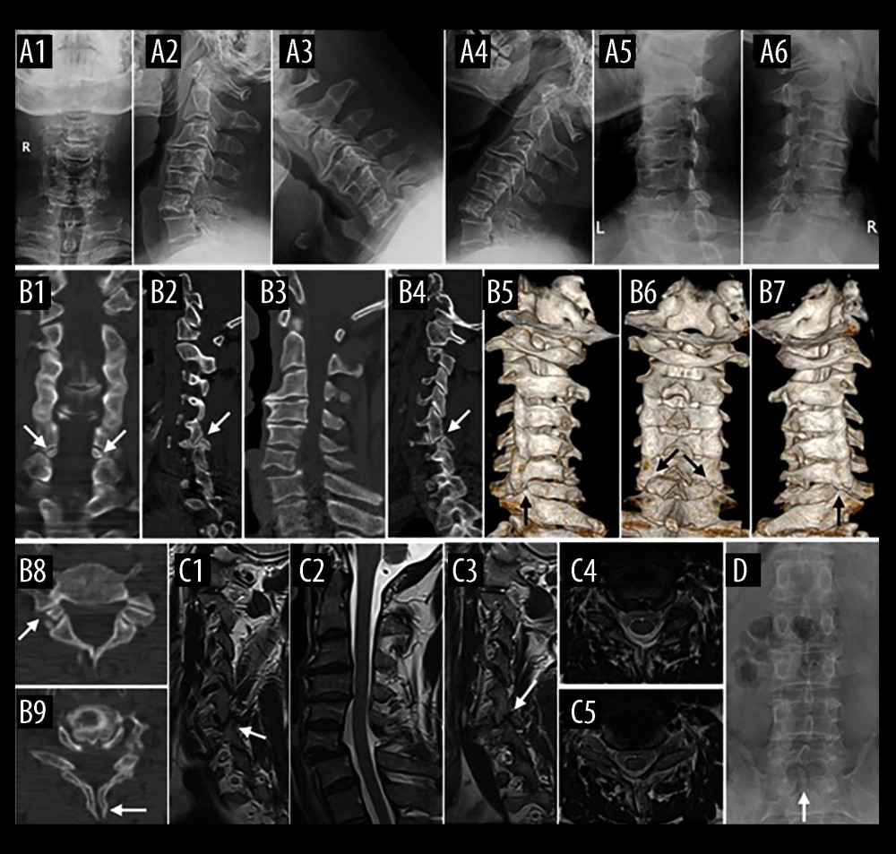 Preoperative X-ray (A1–A6), computed tomography (B1–B8), and magnetic resonance imaging (MRI) (C1–C5) showed bilateral C6 spondylolysis (arrows) and Grade-II spondylolisthesis of C6 on C7. C6–C7 instability was visible by dynamic X-ray (A3, A4). Spinal bifida of C6 (B9, arrow) and S1 (D, arrow) were present. MRI showed no cord compression or multilevel disc with degeneration sign (C2).