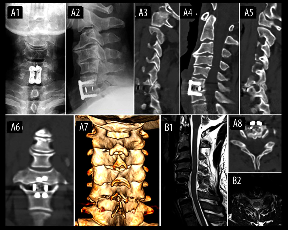 Immediate postoperative X-ray (A1, A2), computed tomography (A3–A8), and magnetic resonance imaging (B1, B2) showed appropriate internal fixation and successful restoration of sagittal alignment.