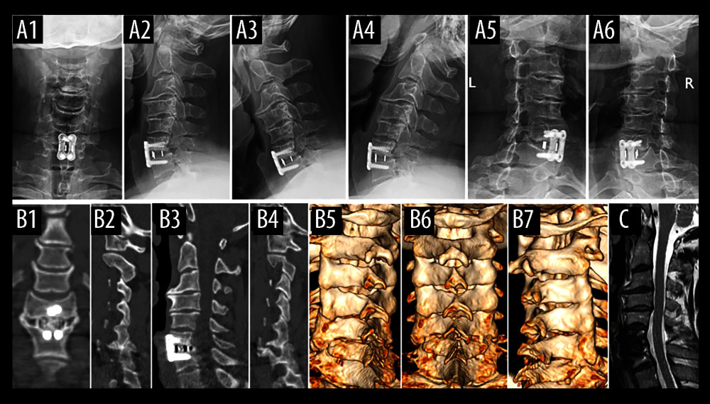 X-ray (A1–A6), computed tomography (CT) (B1–B7), and magnetic resonance imaging (C) at 3-month follow-up showed that C6–C7 intervertebral fusion was achieved and alignment was maintained after surgery. The CT scan showed that the bilateral pars interarticularis defect at the C6 level had narrowed, and showed signs of fusion.
