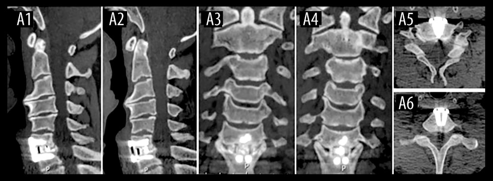 Computed tomography scan (A1–A6) at 2-year follow-up showed that C6–C7 intervertebral fusion and sagittal alignment were maintained.