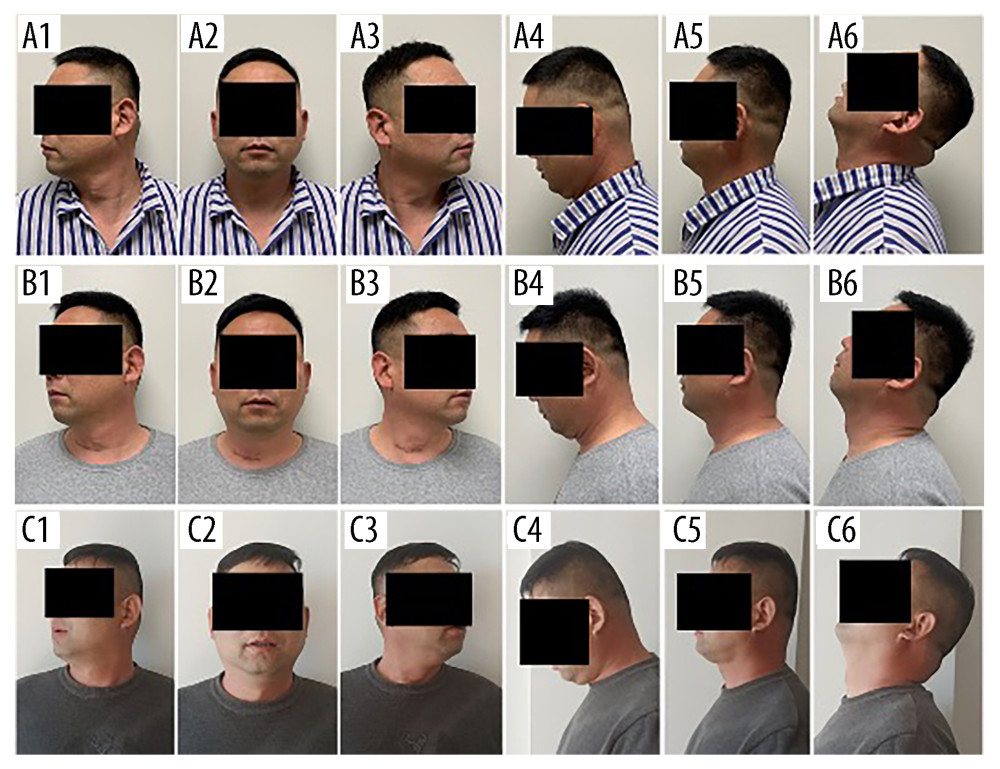 The range of motion of the patient’s neck before surgery (A1–A6), at 3-months (B1–B6), and at the 2-year follow-up (C1–C6).