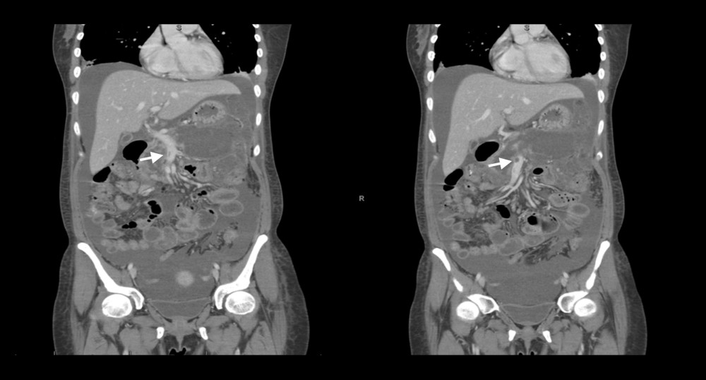 Contrast computed tomography of the abdomen. Arrow shows superior mesenteric vein thrombosis.