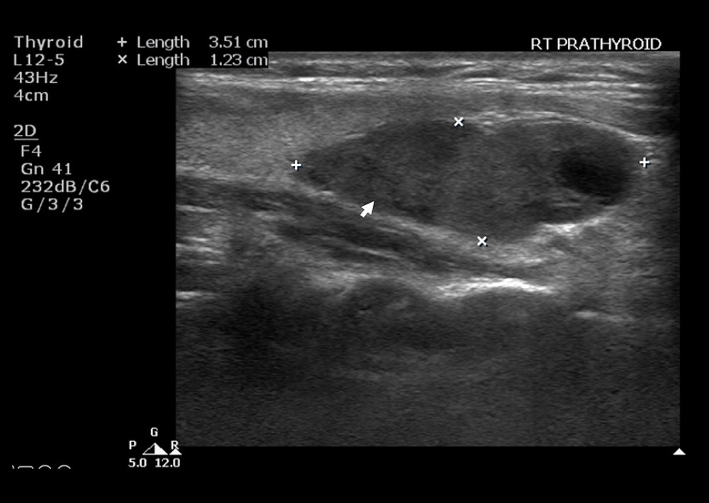 Parathyroid ultrasound: Arrow shows evidence of a large right parathyroid hypoechoic solid mass measuring 3.5×1.2 cm with cystic changes.