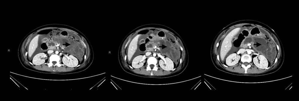 Contrast computed tomography of the abdomen, with arrow showing severe diffuse necrotizing pancreatitis of almost the whole pancreas (body and tail).