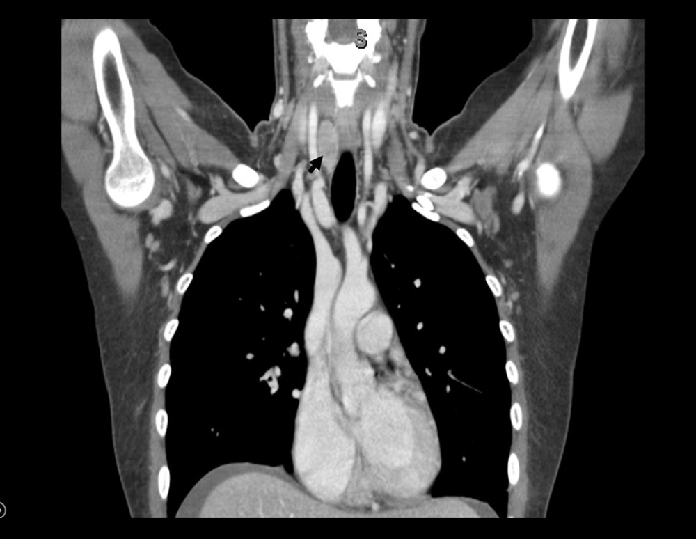 Computed tomography with contrast, with arrow showing a lesion inferoposterior to the right thyroid lobe, with features suggestive of a parathyroid adenoma.