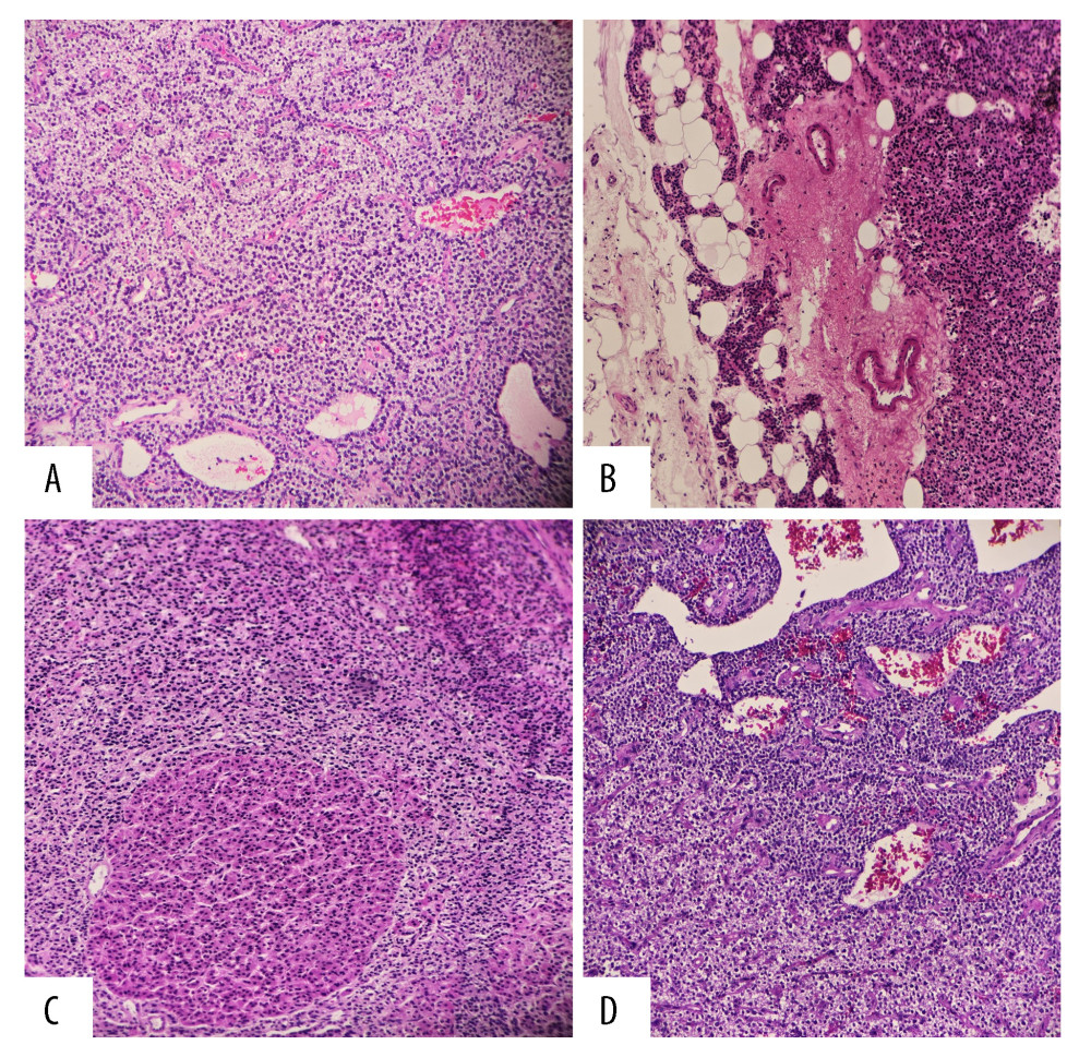 Histopathology of the excised parathyroid gland; hematoxylin and eosin 100×. (A) Clear cells in the upper field and chief cells in the lower field forming acinar structures are shown. (B) Parathyroid adenoma tissue is shown on right side, normal parathyroid is pushed to the left, in between is fibrous capsule. (C) Nodule of oncocytic cells in the lower half with surrounding chief cells are shown. (D) Left lower corner are clear cells and right upper corner are chief cells surrounding ectactic blood vessels.