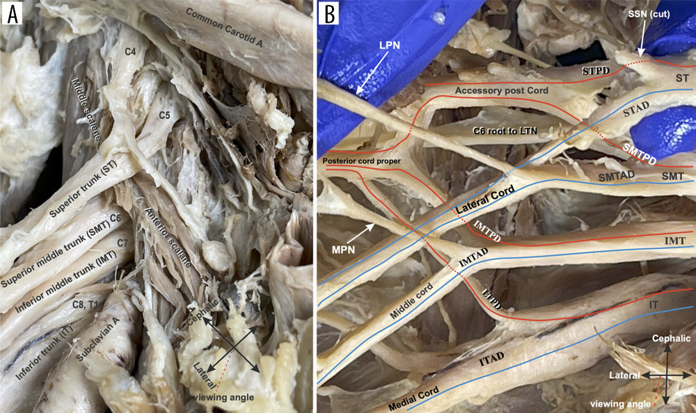 Anomalies in the proximal part of the brachial plexus. (A) Image of the roots and trunks of the anomalous plexus showing the C4 and C5 roots emerging anterior to the anterior scalene muscle and joining to form the superior trunk (ST). The anterior rami of nerve roots C6 and C7 emerged between the anterior and middle scalene and continued laterally to form the superior middle and inferior middle trunks (SMT and IMT, respectively). Nerve roots C8 and T1 joined to form the inferior trunk (IT). (B) A high-magnification image of the distal portion of the trunks and divisions re-joining to form cords. Blue lines indicate contributions to the anterior divisions and red lines indicate contributions to the posterior divisions. Hidden portions of the divisions are indicated by dashed red and blue lines. Cadaveric orientation and viewing angle are by cardinal arrows the red dashed line in the lower right corner, respectively.