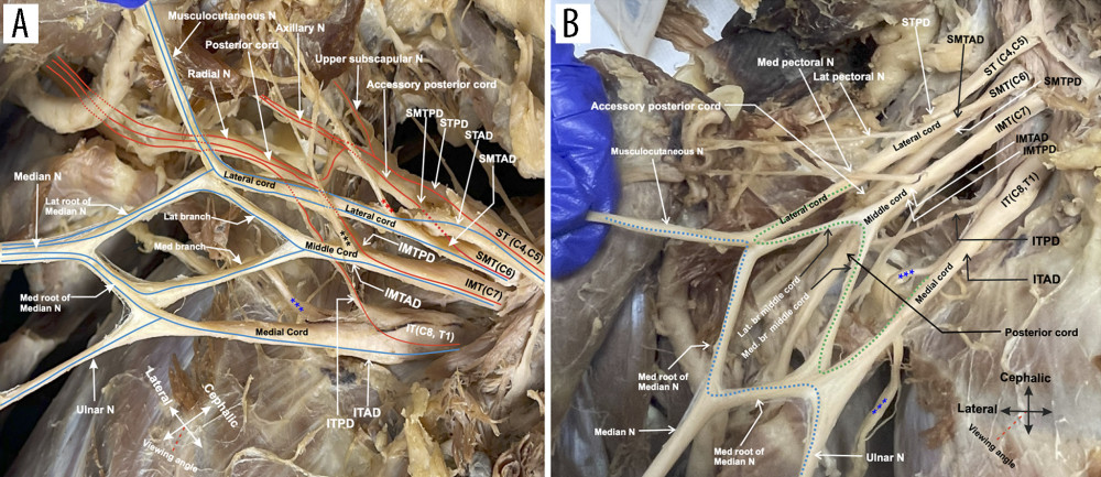 Terminal branches of the anterior divisions and cords. (A) Low-magnification image of superficial structures of the brachial plexus which demonstrates most of the trunks and cords, especially cord arising from the anterior divisions. Blue lines indicate contributions to the anterior divisions and red lines indicate contributions to the posterior divisions. Blue stars indicate the medial antebrachial cutaneous nerve, red stars indicate the lateral pectoral nerve, and black stars indicate the medial pectoral nerve. (B) Image of the double M structure in the distal plexus. The inverted M (highlighted by green dotted line) is formed by the bifurcation of the middle cord, medial cord, and lateral cord. The upright M (highlighted in blue dotted line) is formed by the medial and lateral root of median nerve along with the ulnar and musculocutaneous nerves. Together, the 2 Ms form a diamond pattern.
