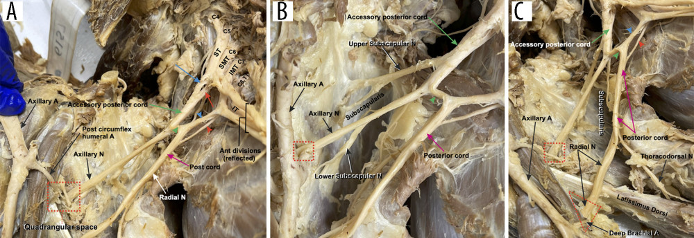 Terminal branches of the posterior divisions and cords. (A) A low-magnification image of the posterior divisions forming the posterior cord and posterior accessory cord. Images were taken after the anterior divisions had been cut and reflected. The STPD (blue arrow) joined the SMTPD (red arrow) to form the accessory posterior cord (green arrow). The IMTPD (blue arrowhead) joined the ITPD (red arrowhead) along with a branch from the accessory posterior cord (green arrowhead) to form the posterior cord (magenta arrow). (B) A magnified image showing the branches of the accessory posterior cord (green arrow). The accessory posterior cord gave off the upper subscapular nerve (labeled), a root to the posterior cord (green arrowhead), the lower subscapular nerve, and continued as the axillary nerve into the quadrangular space (red dashed square). (C) A magnified image focused on the branches of the posterior cord. Arrow color labels correspond with panel A. The posterior cord gave off the thoracodorsal nerve and continued as the radial nerve, which entered into the triangular interval (red dashed triangle).