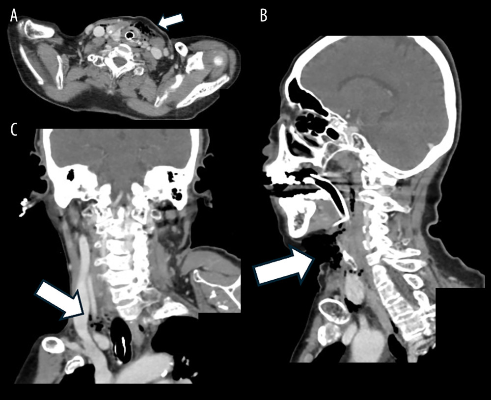Venous phase contrast-enhanced computed tomography (CT) of the neck (A: axial, B: sagittal, C: coronal). The arrows indicate the injury site in the neck. Contrast enhancement of the major vessels in the neck is maintained. Mild damage to the thyroid and larynx was observed during surgery, but no obvious damage of vasculature is seen on CT.