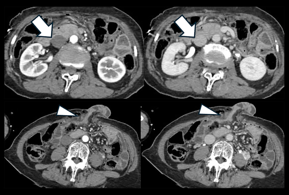 Abdominal contrast-enhanced axial CT showing arterial and venous phases at the IVC level and at the level of intestinal prolapse. The IVC, indicated by arrows, shows no obvious injury or surrounding hematoma. The intestinal prolapse is indicated by arrowheads.