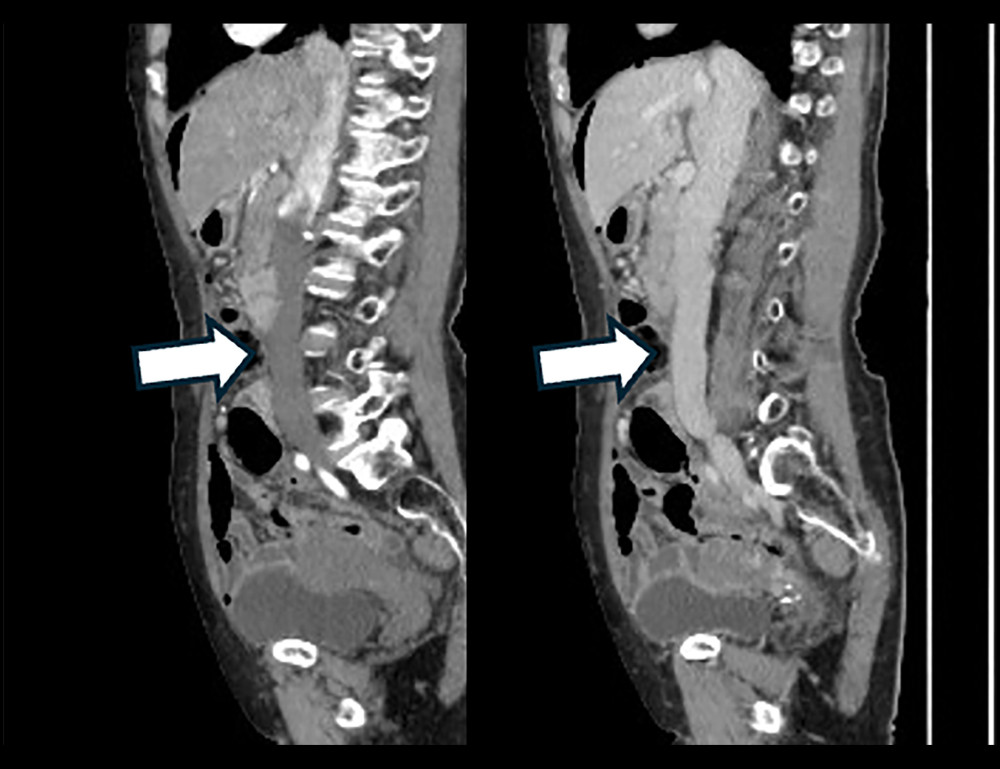 Abdominal contrast-enhanced sagittal CT, arterial, and venous phases. The IVC is indicated by arrows. Even on sagittal CT, no vascular damage or hematoma suggesting IVC damage is seen.