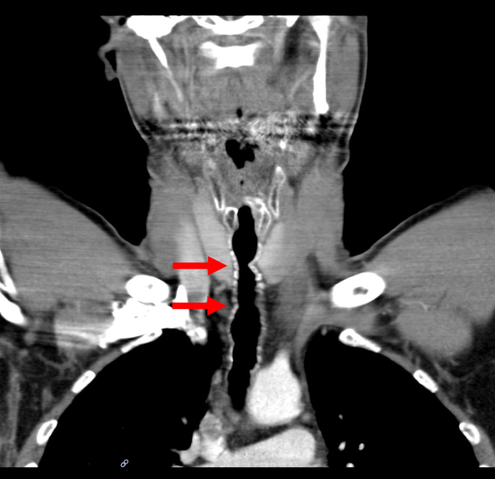 Computed tomography images of the neck. First clinical presentation in 2006 showing tracheal constriction, deviation, and loss of wall thickness (red arrows).