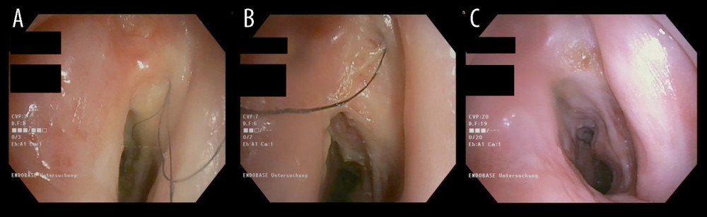 Bronchoscopic images of the patient’s tracheal lumen before (A, B) and after (C) integral restitution. Image A was taken in 2016, image B in 2019, and image C in 2022. A and B show endotracheal hair growth and fibrinous coating. In C, hair growth had been successfully terminated and the tracheal skin graft appears structurally improved in direct comparison. Additionally, there is a small scar of laser coagulation in the same location as in A and B.