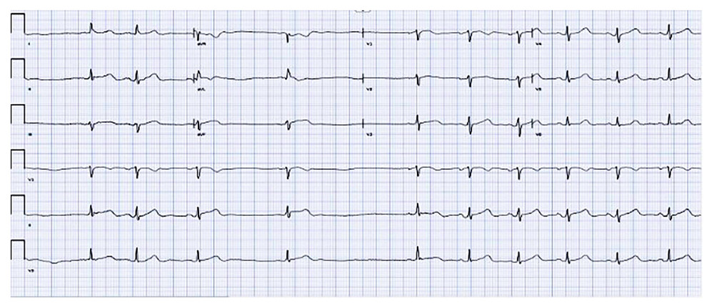 Electrocardiogram on admission was significant for sinus arrhythmia, HR 63, PR 152ms constant, QTc 415 ms.
