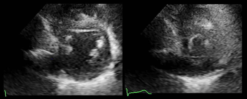 Stress echocardiogram in PSAX. The patient demonstrated good contractility with an absence of wall motion abnormality when stressed.