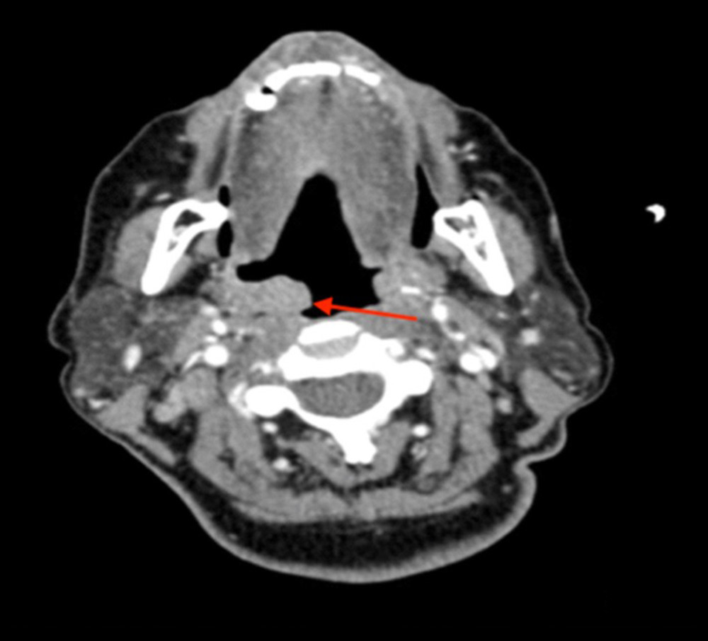 CT neck without contrast revealing extension of the right tonsillar mass.