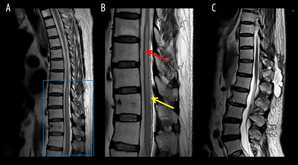 T2-weighted magnetic resonance imaging shows high signal intensity within the spinal cord (indicated by the red arrow), with spinal cord swelling below T7. A tortuous vascular flow shadow can be seen on the dorsal side (indicated by the yellow arrow). (A) T2-weighted imaging. (B) Enlargement of the blue box area in Figure A. (C) Postoperative magnetic resonance imaging shows the vascular flow shadow disappeared.