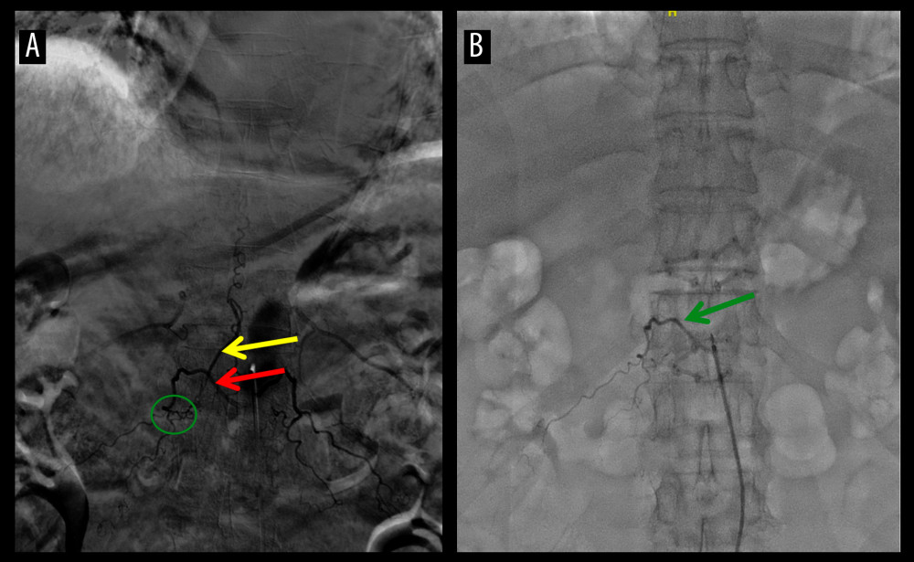 Spinal cord angiography shows the supplying artery (red arrow), fistula opening (green circle), and dilated draining vein (yellow arrow). The fistula is located at the level of the 12th thoracic vertebra, and the intercostal artery is the supplying artery. After surgery, the fistula disappeared (green arrow). (A) Preoperative super-selective whole-brain and spinal angiography. (B) Postoperative super-selective whole-brain and spinal angiography.