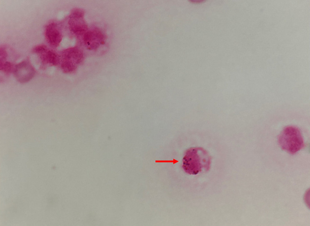 Gram stain in cerebrospinal fluid showed many polymorphic cells and high, rapidly phagocytosed gram-positive diplococci (red arrow).