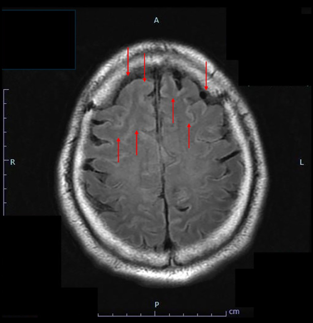 FLAIR brain magnetic resonance imaging on admission showing high signal intensity in the cerebral sulci (red arrow), raising suspicion for meningitis. There is no significant signal change within the brain parenchyma.