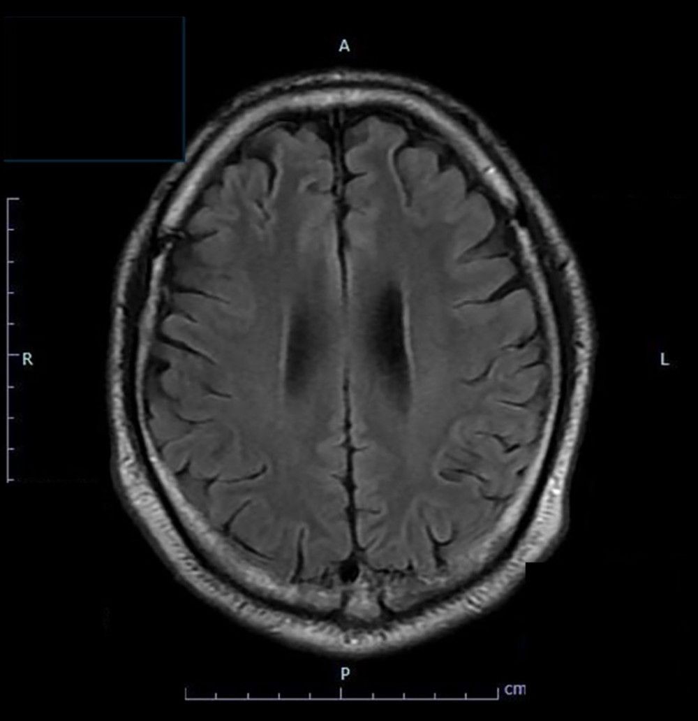 FLAIR brain magnetic resonance imaging 19 days after admission. The cerebral sulci are clearly delineated, suggesting improvement.