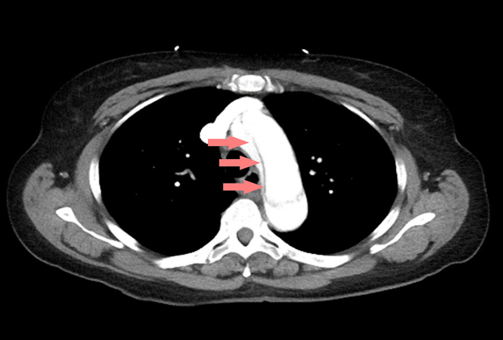 Computed tomography with IV contrast demonstrating a Stanford Type A aortic dissection. Arrows indicate intimal flap.