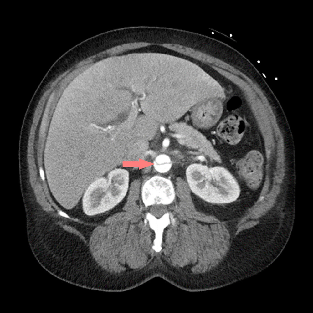 Computed tomography with IV contrast demonstrating extension of the aortic dissection to the level of the renal system. Arrow indicates intimal flap.