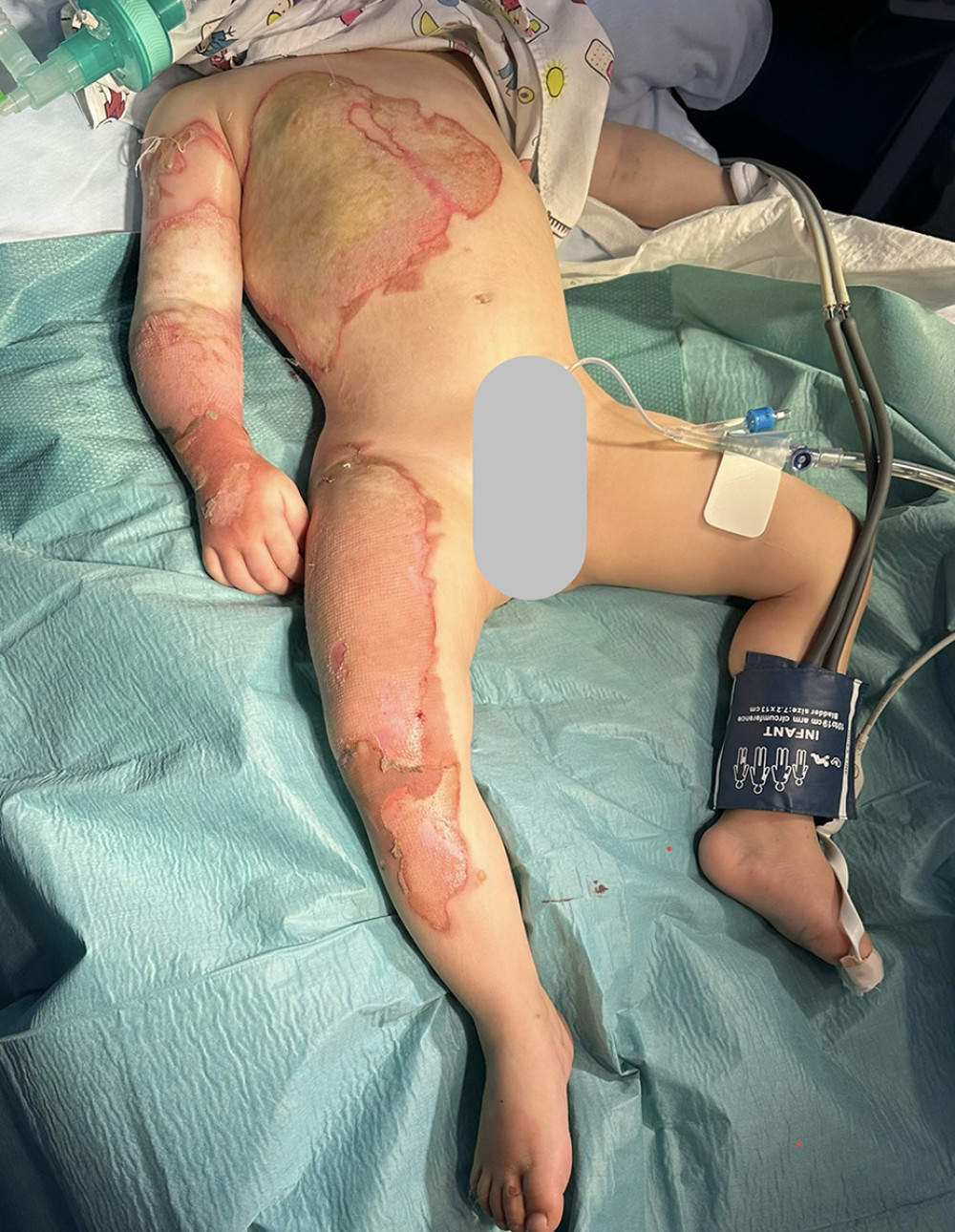 After anesthesia induction, and before applying dressings to the affected areas on the right side, the surgical team prepared the wounds.