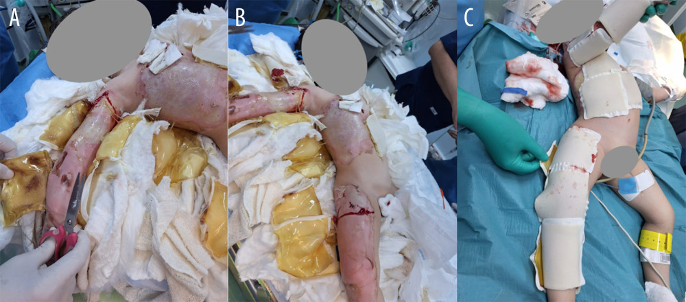 Sequential intraoperative and postoperative wound dressing in the operating room. (A) Shows a patient’s upper extremity after Elasto-Gel dressing removal, with the right arm prominently displayed. The right arm and chest wall show deeper third-degree, yellowish-dark eschar underlying the tissues. (B) Provides a view of the same involved sites, including the patient’s right leg. (C) Shows the area after the application of Elasto-Gel absorbent wound dressing, followed by a bulky dressing using cotton, gauze, and crepe bandage.