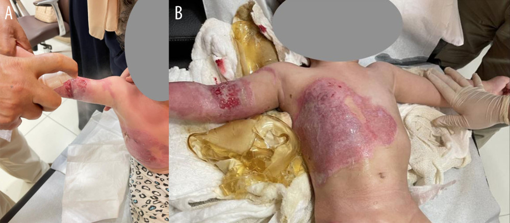 During follow-ups at the clinic, (A) was taken 3 days after discharge, showing second-degree scald burns on the right upper limb, chest wall, and right lower limb, covering 30% of the surface area after the removal of the Elasto-Gel dressing. (B) Taken on 30 September, shows a close-up view of the patient’s right arm, revealing a full-thickness burn and skin loss. Most of the burns on other sites have healed.
