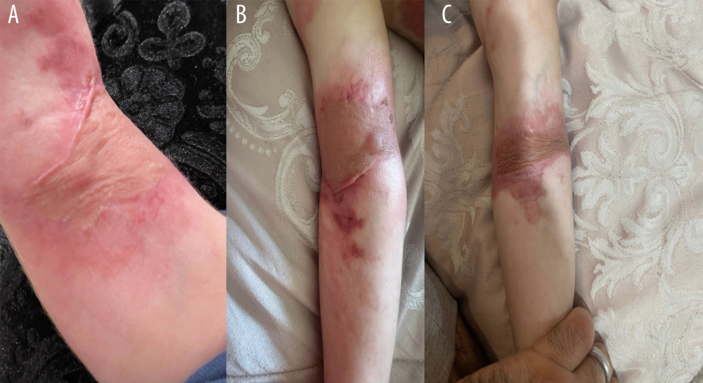Close-up views of a patient’s forearm show the postoperative healing progression of a skin graft. (A) Shows the initial appearance 2 days after surgery. (B) Taken 10 days postoperatively, illustrates the condition at an intermediate stage, with a partial reduction in erythema and early signs of graft integration. (C) shows the forearm at a more advanced stage of healing, demonstrating further reduction in inflammation, improved skin texture, and maturation of the graft site 1 month after the procedure.