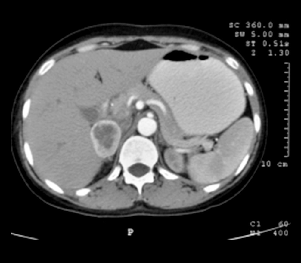Contrast-enhanced computed tomography of the abdomen showing right adrenal pheochromocytoma. Arrow showing right (4×3 cm) adrenal pheochromocytoma.