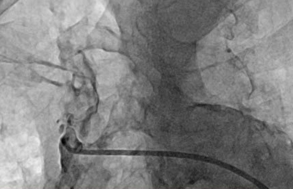 The aortic arch computed tomography angiography revealed absent flow in the supra-aortic branches.