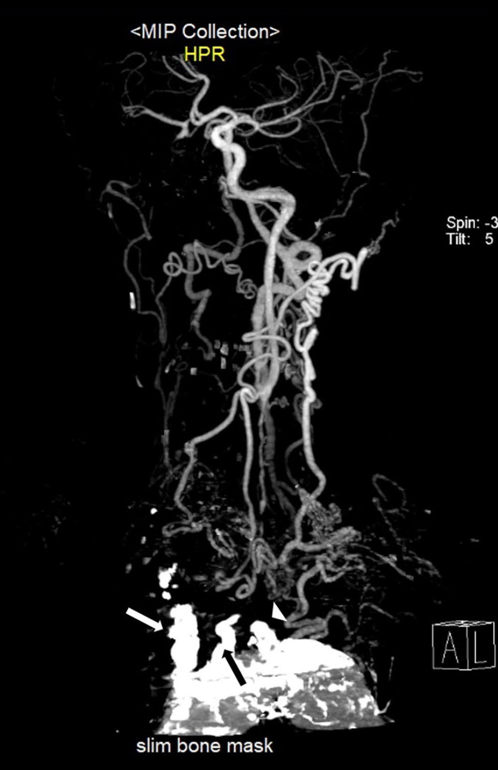 Porcelain aorta and supra-aortic vessels cut-off. Computed tomography angiography of the aortic arch and cerebral arteries showed the porcelain aorta with total cut-off of all supra-aortic vessels, including right brachiocephalic (white arrow), left common carotid (black arrow), and left subclavian artery (arrowhead)