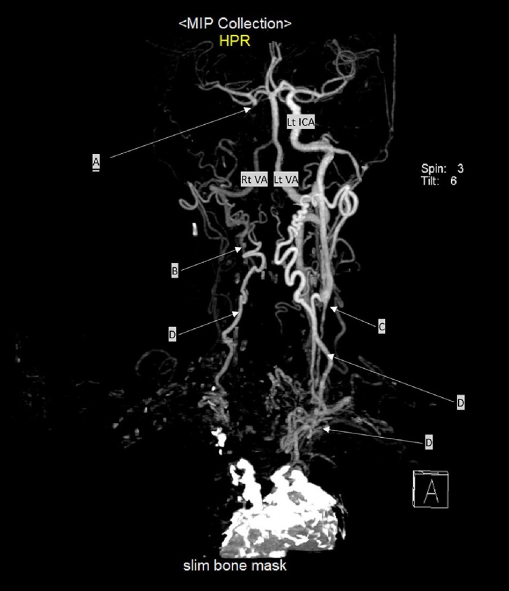 Computed tomography angiography of the aortic arch and cerebral arteries reveals significant findings, including the total absence of the right internal carotid artery A), a proximal cutoff of the right vertebral artery B), a proximal cutoff of the left internal carotid artery C), and the presence of multiple collateral formations originating from the aorta D). Lt – left; Rt – right; ICA – internal carotid artery; VA – vertebral artery.