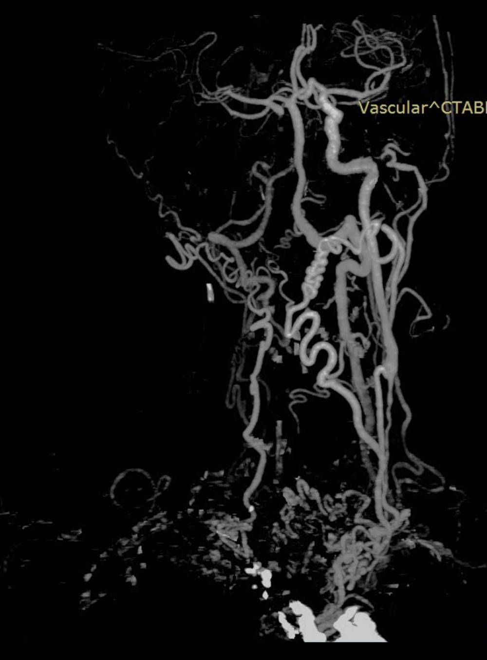 Follow-up brain and neck computed tomography angiography of the patient at the 4-month follow-up.
