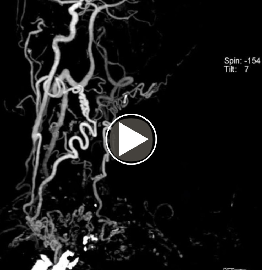Computed tomography angiography shows porcelain aorta and occluded all supra aortic vessels and vast collaterals filling intracranial vessels from the aorta itself.