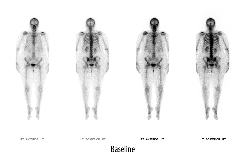 Technetium Tc 99m medronate injection, 22.6 mCi, whole skeleton bone scan early in the patient’s course with coccidioidal meningitis, identifying degenerative changes consistent with age and prior injuries.