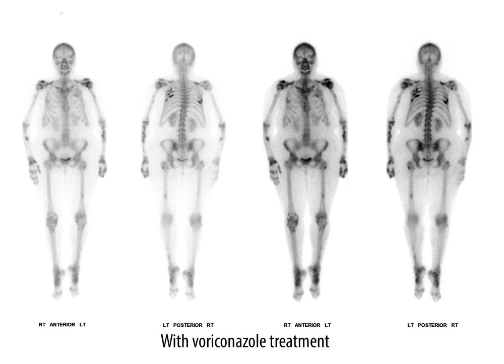 Technetium Tc 99m medronate injection, 22.6 mCi, whole skeleton bone scan, while treated with voriconazole. Patient had severe diffuse pain. Findings include multifocal sites of markedly abnormal uptake in the upper posterior lateral ribs bilaterally, heterogeneous sites of abnormal uptake throughout both arms and scapula, left greater than right, and in the small joints of the hands. The left tibia, left femur, and uptake in the small joints of the feet were also noted to be increased.