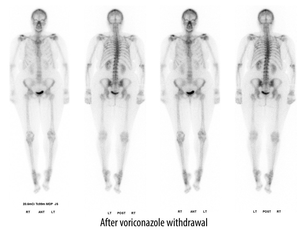 Technetium Tc 99m medronate injection, 22.6 mCi, whole skeleton bone scan, 4 months after stopping voriconazole, with resolving multifocal lesions.