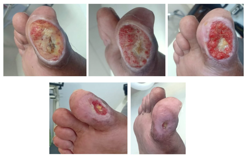 Wound repair over time.