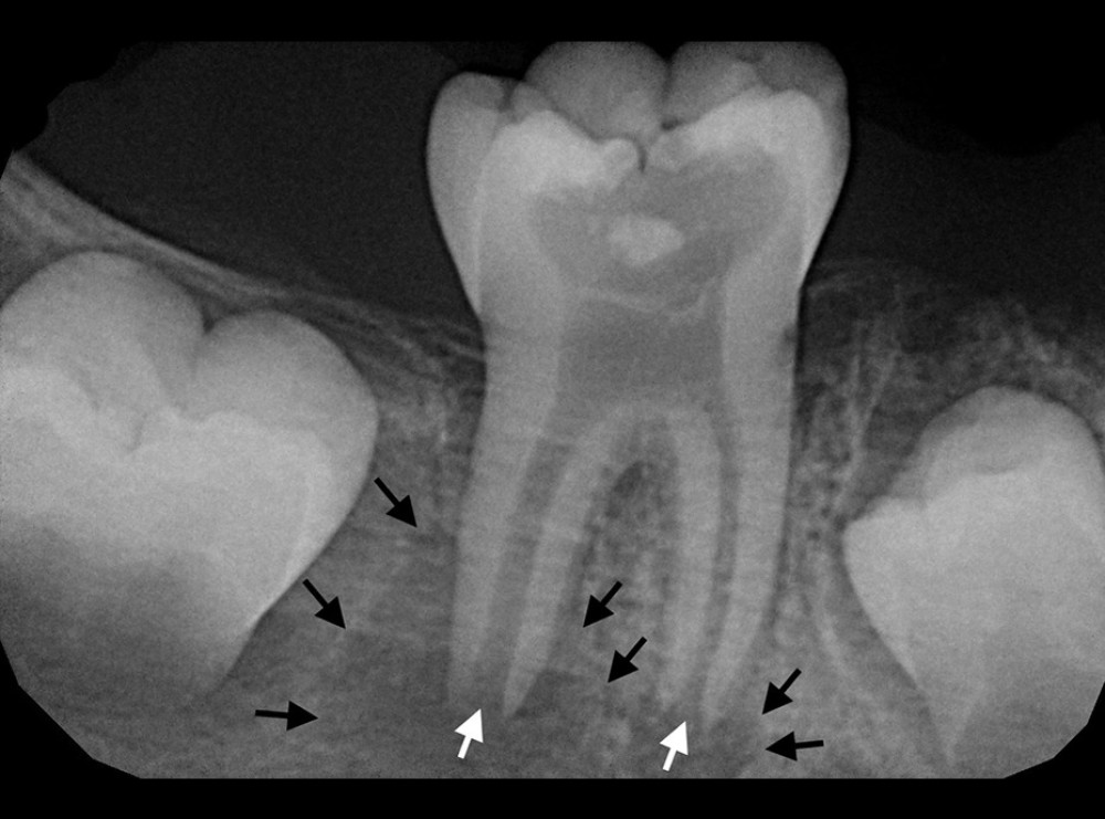 Preoperative radiographs showing deep caries, highlighting periapical radiolucency (black arrows) related to immature roots (white arrows) of tooth number 46.