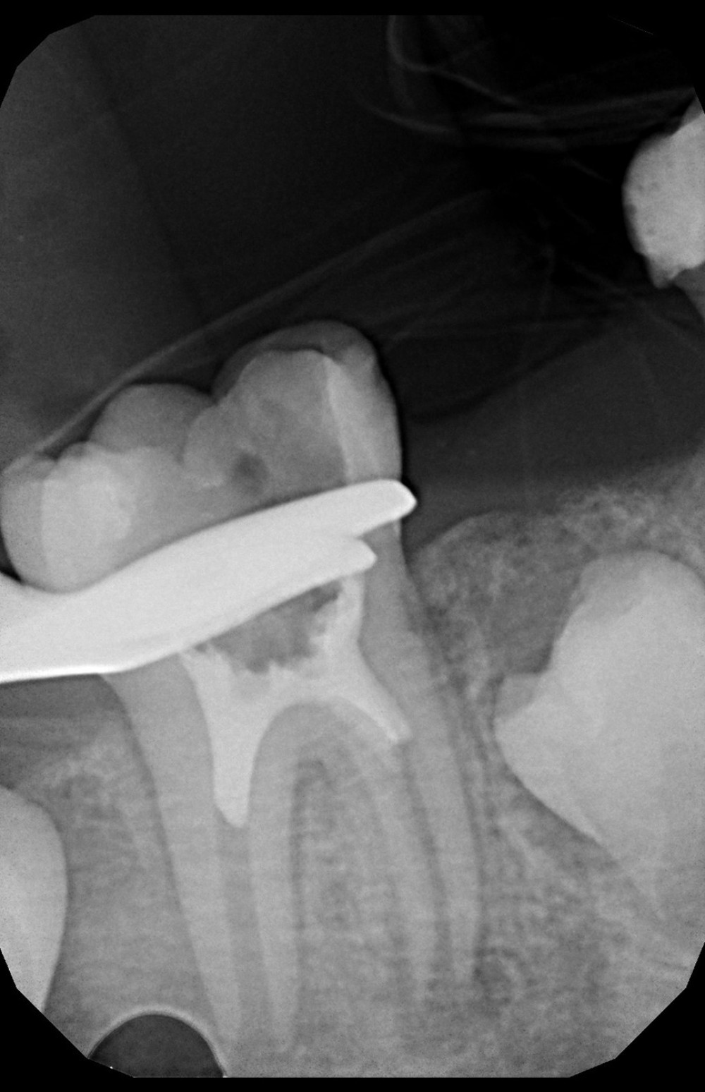 Periapical radiograph showing MTA plug in the coronal third (4 weeks after the initial visit).