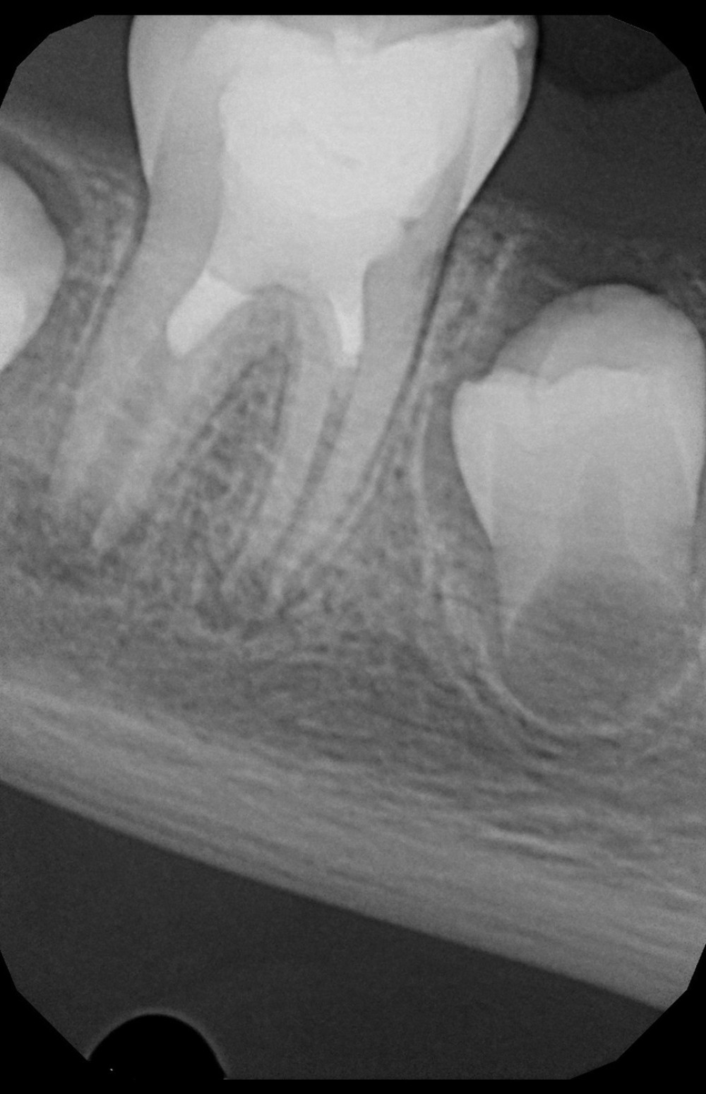 Periapical radiograph after restoring the tooth with a composite filling (8 weeks after the initial visit).