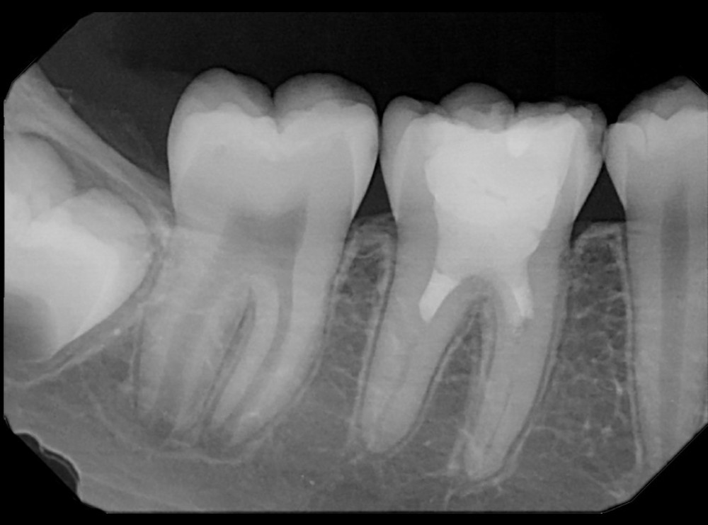 After 5 years, periapical radiograph shows complete periapical healing, apical closure, increased root length, increased dentin thickness, and narrowed canal spaces.