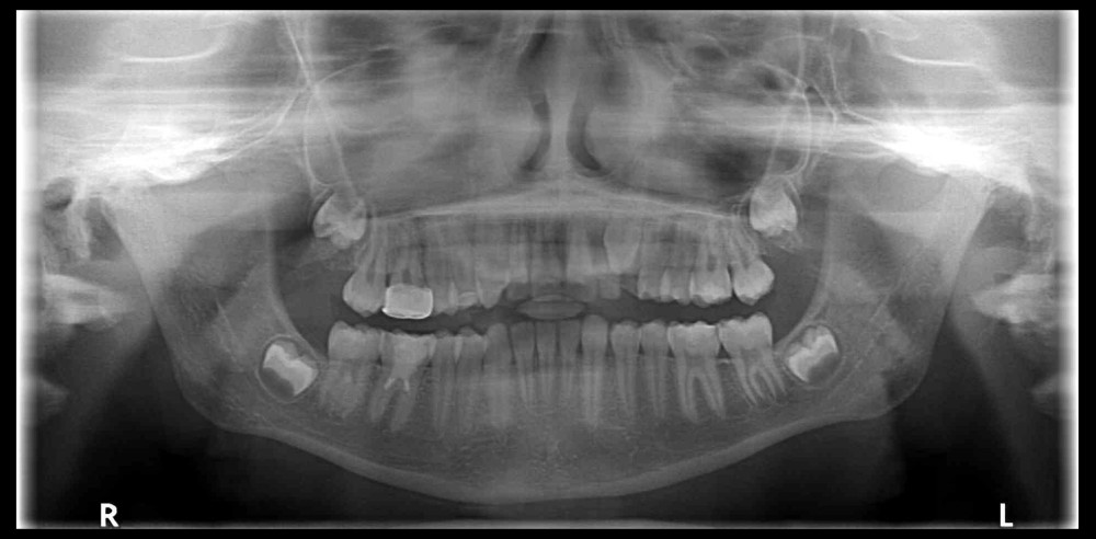 After 5 years, the panoramic radiograph indicates that the root length of tooth number 46 closely matches that of its counterpart tooth.
