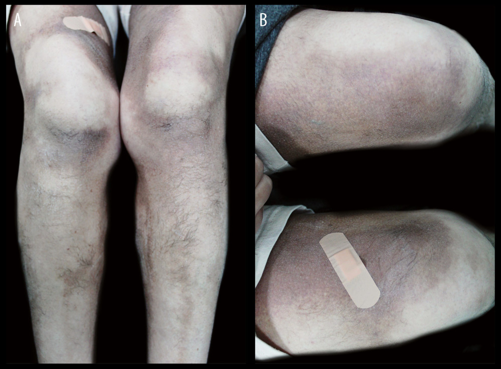 (A) Hyperpigmented-violaceous sclerotic plaques symmetrically involving the bilateral inner thighs, inner legs, and lower knees. (B) Close-up view of the sclerotic skin changes showing the hypertrichosis.