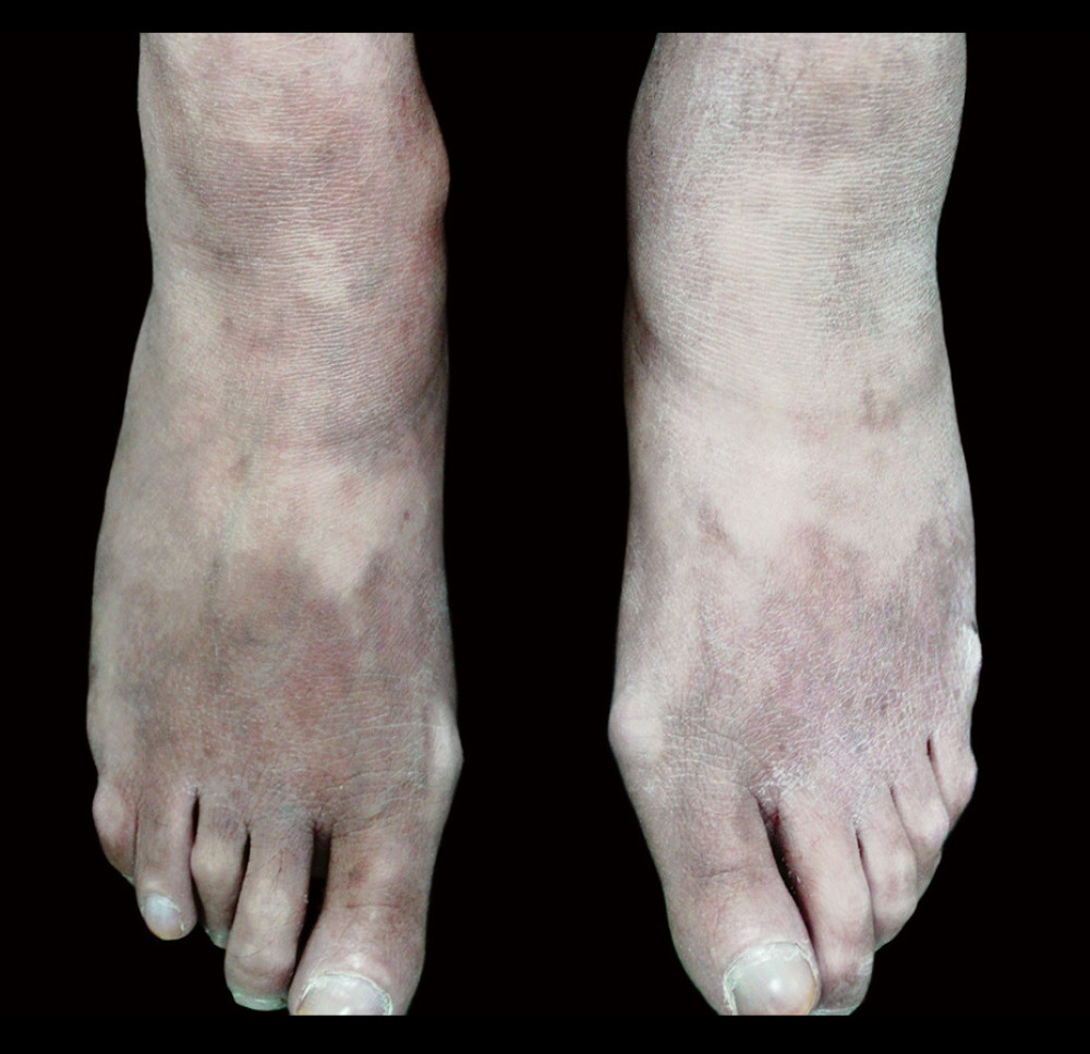 The pigmented sclerosis of the dorsal forefoot, along with the hallux valgus of the big toe.