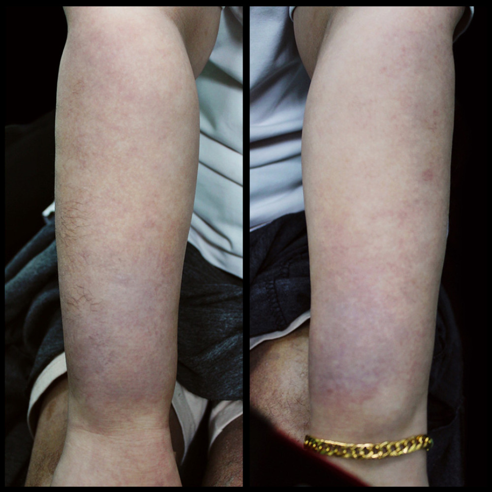 Erythematous to violaceous skin changes of the bilateral dorsal forearms with focal hypertrichosis.